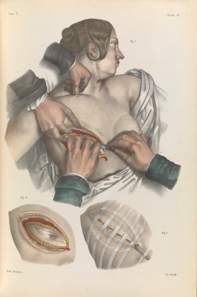 Edward Worth Library Lecture: Surgery and Emotion in the Nineteenth Century