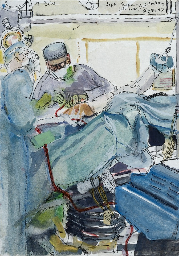 A surgical operation: left scapular osteotomy. Drawing by Virginia Powell, 1997. Credit: Wellcome Collection