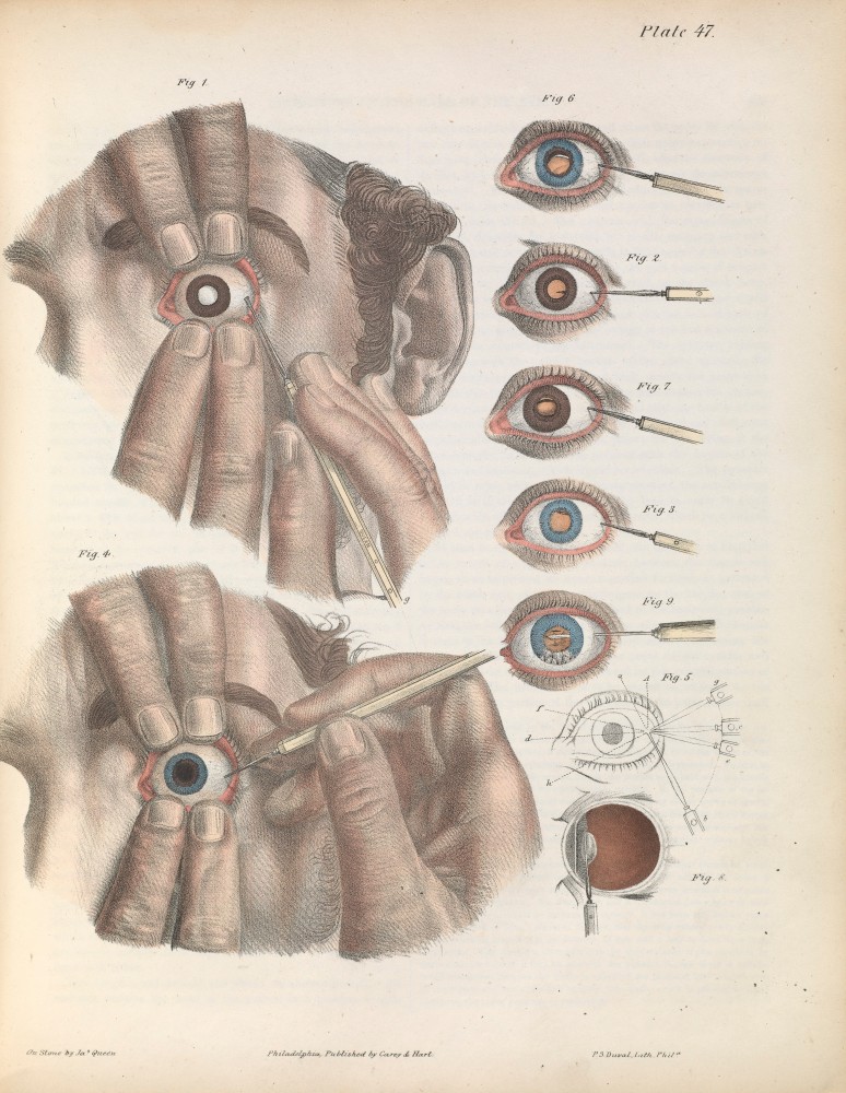 Illustration of surgery on the eye for the removal of a cataract. From Joseph Pancoast's A Treatise on Operative Surgery (1846). Credit: Wellcome Collection.
