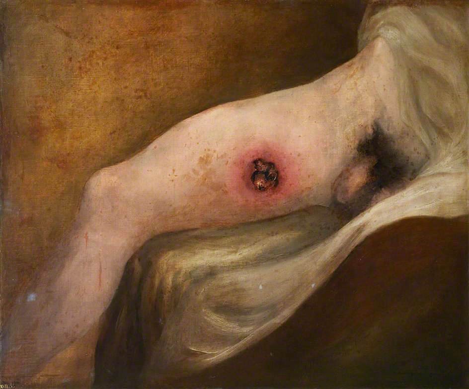 Fig. 2 – Charles Bell, ‘Gunshot Wound of Thigh’ (1809). Royal College of Surgeons of Edinburgh.