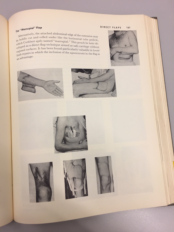 Gillies, Harold, and D. Ralph Millard, Jr. The Principles and Art of Plastic Surgery, vol. 1, p. 151, 1957, published by Butterworth & Co. [full page and detail as featured image]
