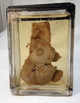 Eyeball specimen with tumour, courtesy of Surgeons’ Hall Museums, The Royal College of Surgeons of Edinburgh.