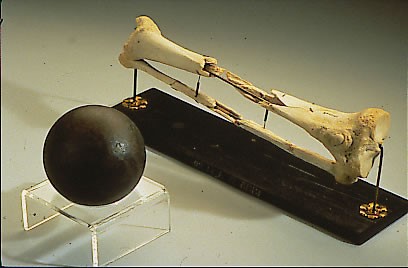 Figure 2 General Sickle’s leg, along with a cannonball similar to the one that shattered it, on display at the National Museum of Health and Medicine, Silver Spring, Maryland. (Wikimedia Commons)